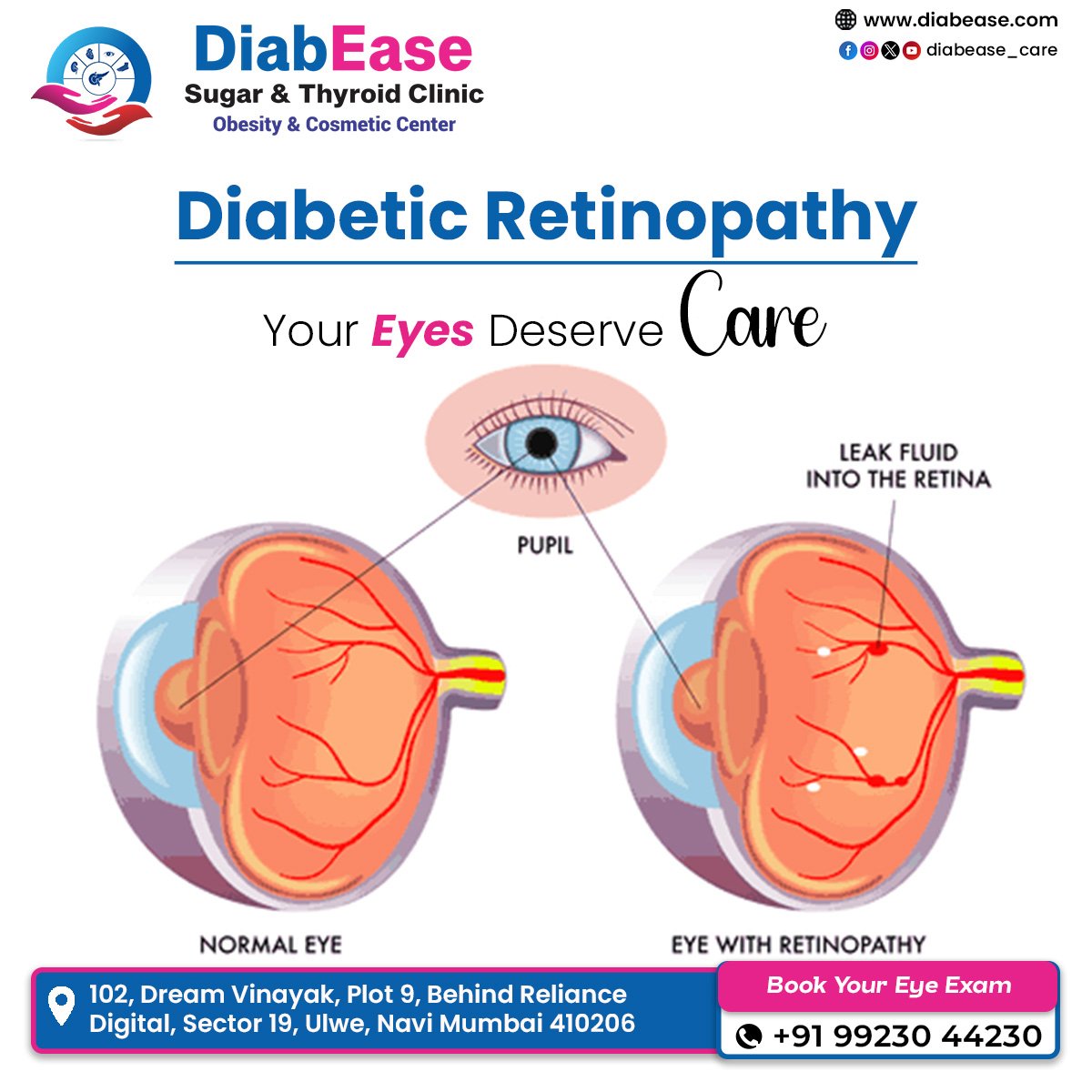 Diabetic Retinopathy Check Up in Ulwe